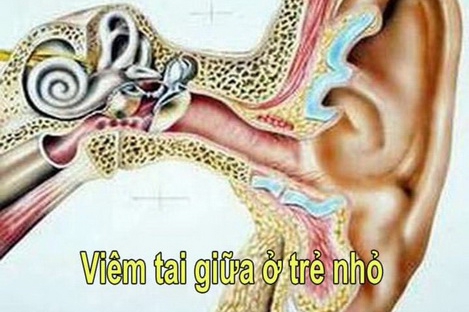 nguy co suy giam thinh luc do viem tai giua o tre em