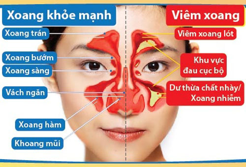 chon thuoc chua viem xoang