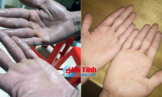 noi soi long nguc cat hach giao cam tri mo hoi tu chi