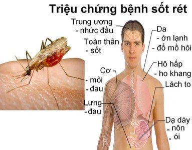 Dấu hiệu của bệnh sốt rét.