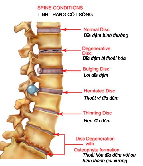 Khám, phẫu thuật các bệnh lý về cột sống tại BVĐK Hà Tĩnh