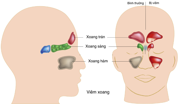 viem mui xoang di ung de tai phat khi chuyen mua