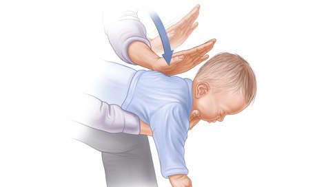 Hướng dẫn sơ cứu xử lý đúng cách khi trẻ bị hóc dị vật đường thở các bậc cha mẹ cần phải biết - phần 1