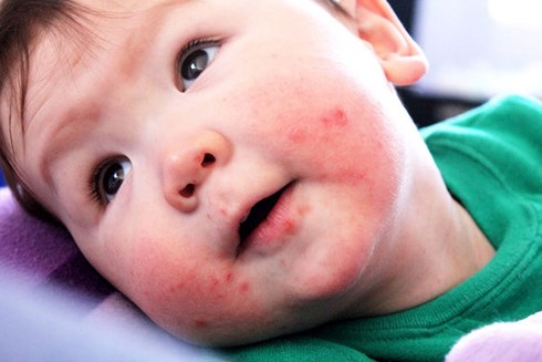 Chủng virus EV71 có nguy cơ gây tử vong ở trẻ